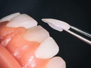 Best Dental implants in kochi