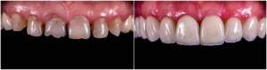 Dental veneer Kadavanthra