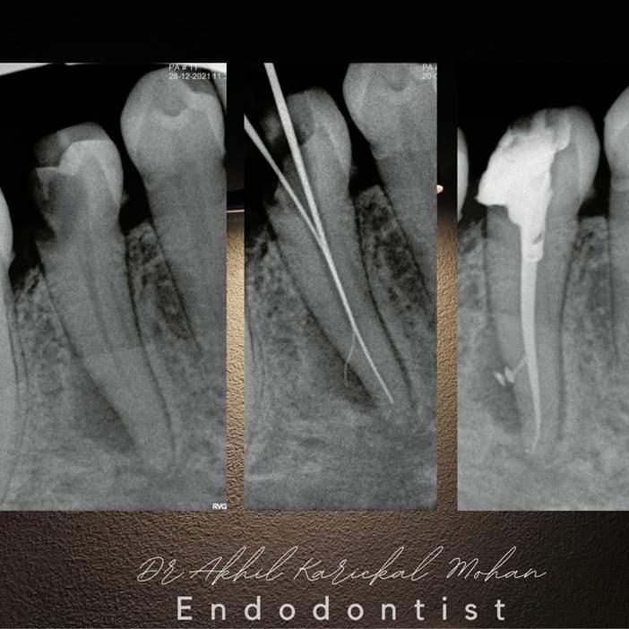 Best Root Canal center in kochi