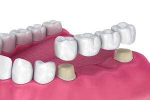 teeth replacement-dental bridges