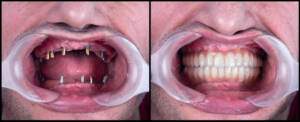 teeth replacement-full mouth implant