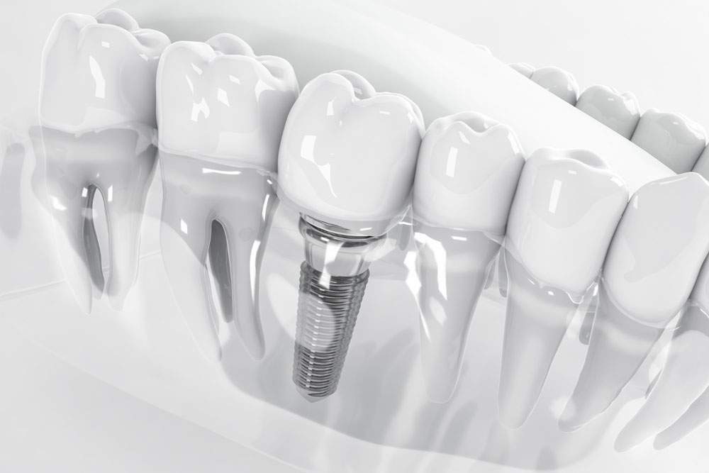 Dental Implants