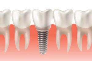 dental-implants