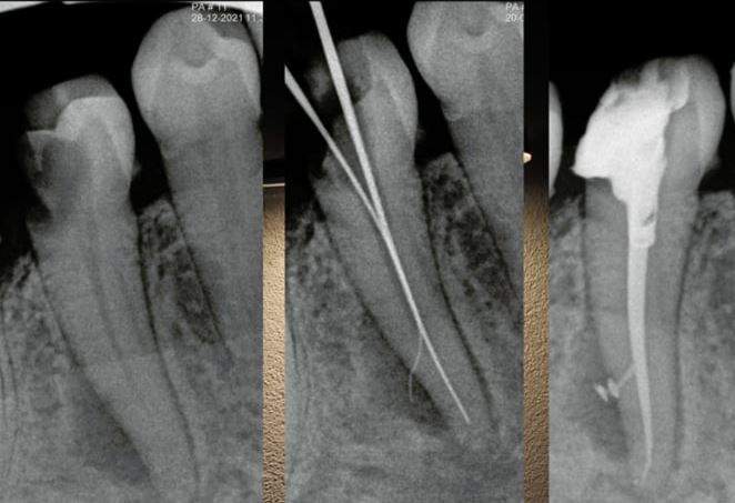 rootcanal