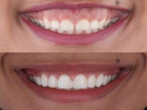 cosmetic-gum-contouring-1