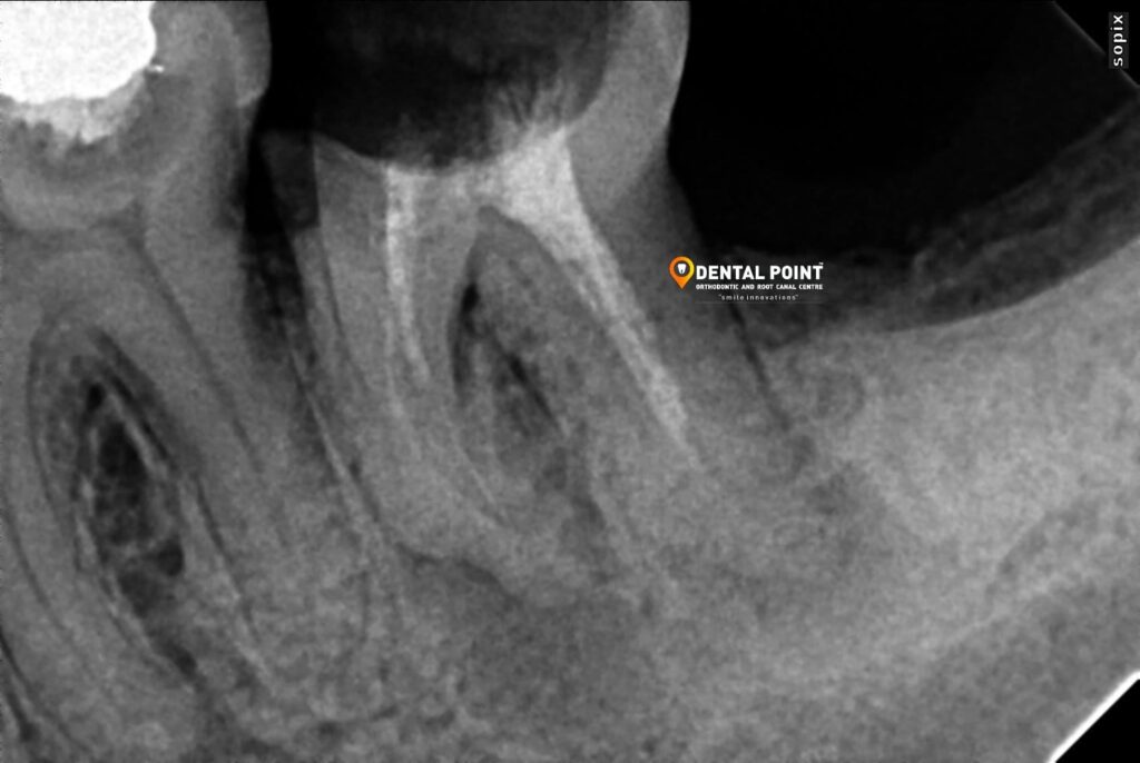 Root Canal Treatment Kochi