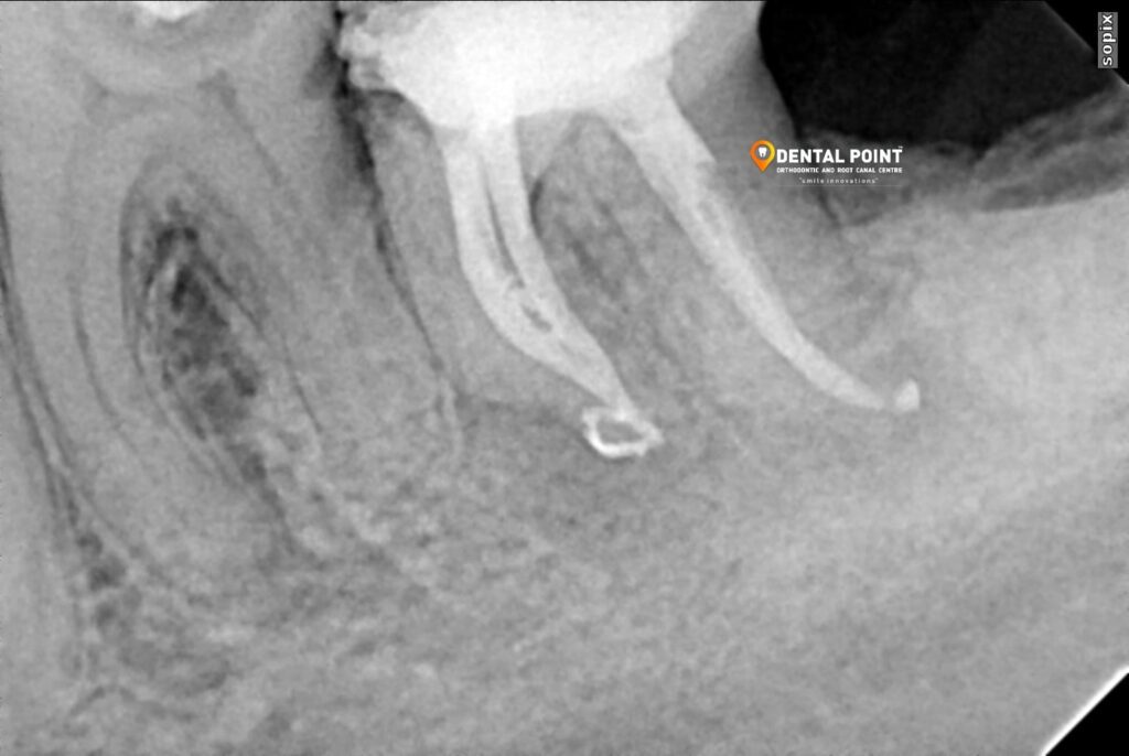 Root Canal Treatment