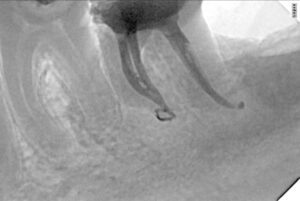 Root Canal Treatment
