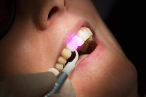 Dental Crown vs Filling
