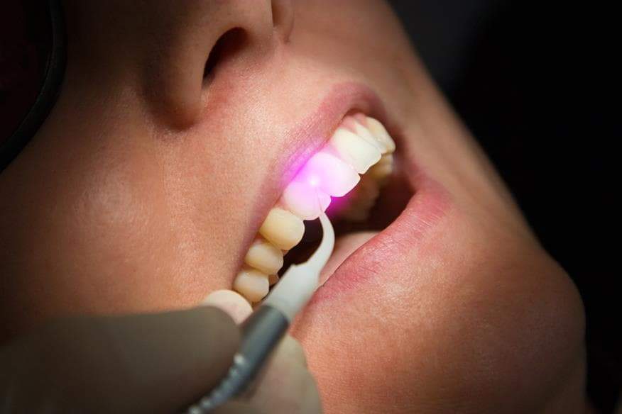 Dental Crown vs Filling